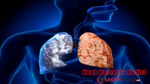 koah-hastaligi-nedir-belirtileri-ve-tedavisi